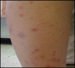 Erythematous macules, Purpuric and urticarial papules, of the lower extremity in a 8-year-old