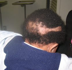 Halo scalp ring is a unique form of annular alopecia involving the vertex of the scalp seen at or shortly after birth, usually in the setting of caput succedaneum.