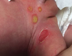  Figure 5. Bullous impetigo in the diaper area.