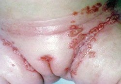  Figure 6. Eczema herpeticum.