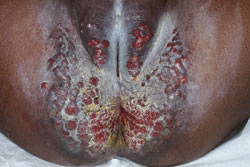  Figure 2. Granuloma gluteale infantum.