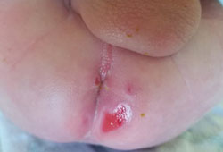  Figure 1. Perianal lesions.