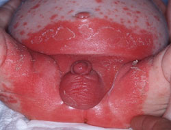  Figure 3. Severe <em>Candida</em> diaper dermatitis.