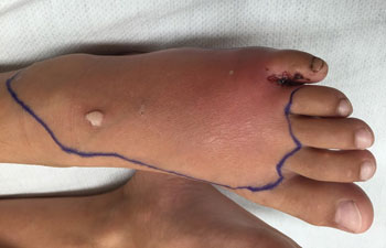 Figure 16. Puncture wound between the 4th and 5th toes. The large wart near the ankle is coincidental.