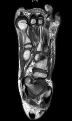 Figure 17. MRI of the foot showing cellulitis and abscess between the 4th and 5th toes.