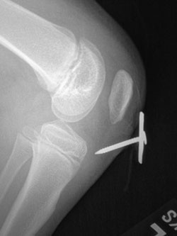 Figure 8. X-ray of the knee with puncture wound showing no bone involvement.