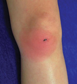 Figure 9. Infected puncture wound of the knee due to Staphylococcus aureus a few days after the injury.