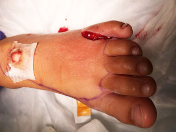 Figure 18. Post-debridement of the puncture wound between the 4th and 5th toes.