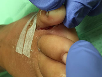 Figure 20. Follow-up appearance of puncture wound between the 4th and 5th toes.