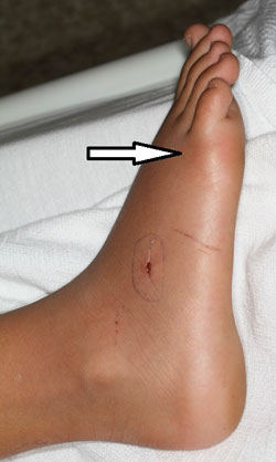 Figure 23. An infected puncture wound caused by broken glass with painful erythema.