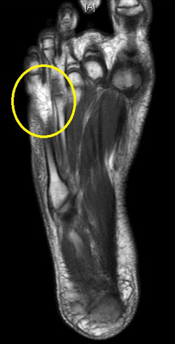 Figure 24. MRI showing osteomyelitis of the distal 5th metatarsal.