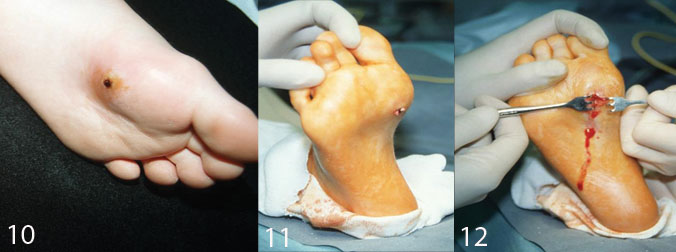 Figures 10-12. Puncture wound of the forefoot, which developed infection twice.