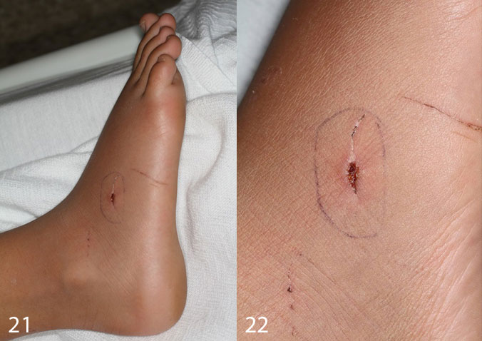 Figures 21 and 22. Puncture wound infection due to a freak accident with a broken plate of glass.