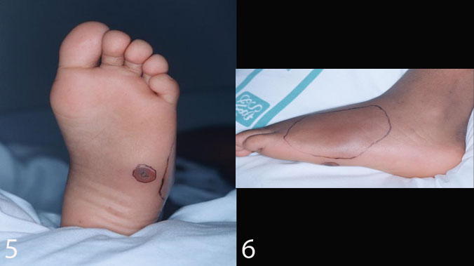 Figure 5-6. Staph cellulitis presenting 3 days after the puncture wound.