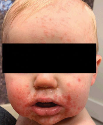 Figure 1. A 1-year old boy presented with a diffuse rash on the body that started on his hands and progressed to include his face and other areas of his body.