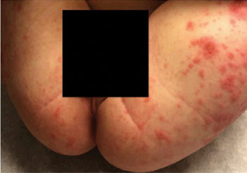 Figure 2. A rash that started on the boy’s hands progressed to include his face, trunk, buttocks, groin, legs and feet.