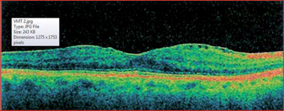 This cataract patient had an epiretinal membrane and was at an increased risk of developing cystoid macular edema after surgery