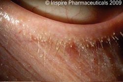 Figure 1: Anterior blepharitis with scurf and loss of cilia.