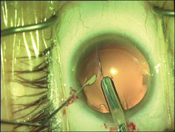 Injection of capsular tension ring in the capsular bag.