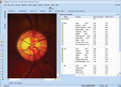 Optic disc and cup markings along with planimetry measurements of optic nerve head image.