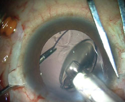 As an IOL is injected into the anterior chamber, the tip of the haptic is caught with MST forceps and brought to the exterior while the injection is continued gently.