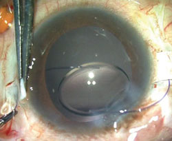 As an IOL is injected into the anterior chamber, the tip of the haptic is caught with MST forceps and brought to the exterior while the injection is continued gently.