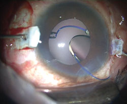 The handshake technique can be used to resolve cases in which one of the haptics is not caught or is inadvertently released. One MST forceps is used to hold the haptic and another forceps is introduced through the opposite sclerotomy or side port.