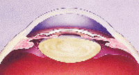 Illustration of Artisan Lens