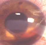 Hyphema