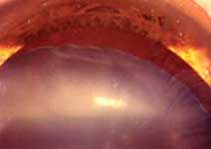 Traumatic cataract