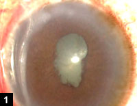 Figure 1: A miotic nondilating pupil can be a barrier to the surgeon