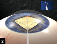 Figure 2: Tri-pronged stretchers are effective in dilating small pupils