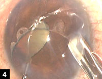 Figure 4: The Perfect Pupil is injected into eye with special injector