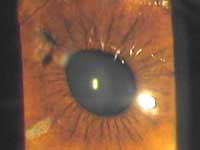 Patient with metallic intraocular foreign body perforating cornea