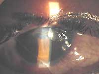 Corneal laceration caused by fragments of stones and sand