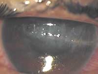 Corneal laceration caused by fragments of stones and sand