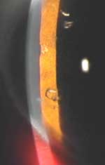 Cornea perforated by small, sharp fragment