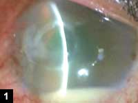 Figure 1: Corneal ulcer with hypopyon after LASIK