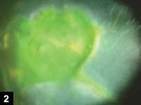 Figure 2: Corneal defect staining with fluorescein