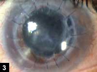 Figure 3: Status post-penetrating keratoplasty