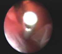 With endoscopic viewing there is no need for scleral depression