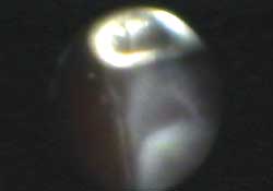 Endoscopic viewing allows panoramic viewing through a tangential approach