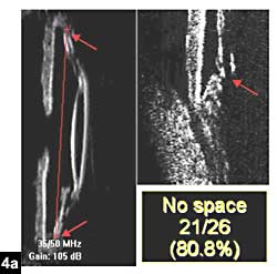 Figure 4a: No space between equator and ciliary ring postoperatively