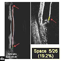 Figure 4b:  Some space between equator and ciliary ring postoperatively