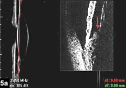 Figure 5a: If capsular bag plane is posterior to ciliary apex, there is no possibiliy of anterior movement