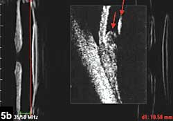 Figure 5b: If capsular bag plane is posterior to ciliary apex, there is no possibiliy of anterior movement