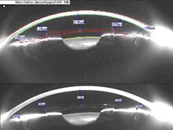 Preop simulation (top) and postop examination (bottom) to determine lens placement