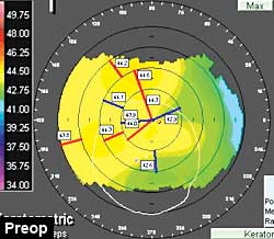 Preop: Astigmatic changes were minimal and compared favorably with the phacoemulsification wound incision