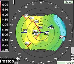 Postop: Astigmatic changes were minimal and compared favorably with the phacoemulsification wound incision