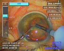 Strong holding force and a stable anterior chamber